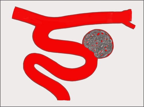 A coil implanted in a ruptured aneurysm to stop bleeding. Illustration courtesy of Dr. Puri.