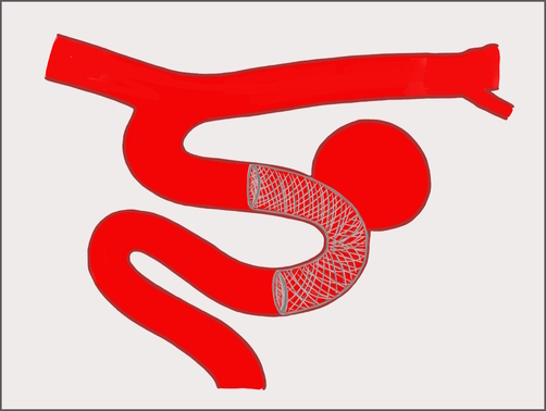 A flow diverter placed across the neck of an unruptured aneurysm. Illustration courtesy of Dr. Puri.