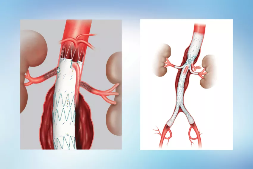 Abdominal Aortic Aneurysms side-by-side Illustrations